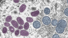 Maryland Department of Health reports monkeypox-related death